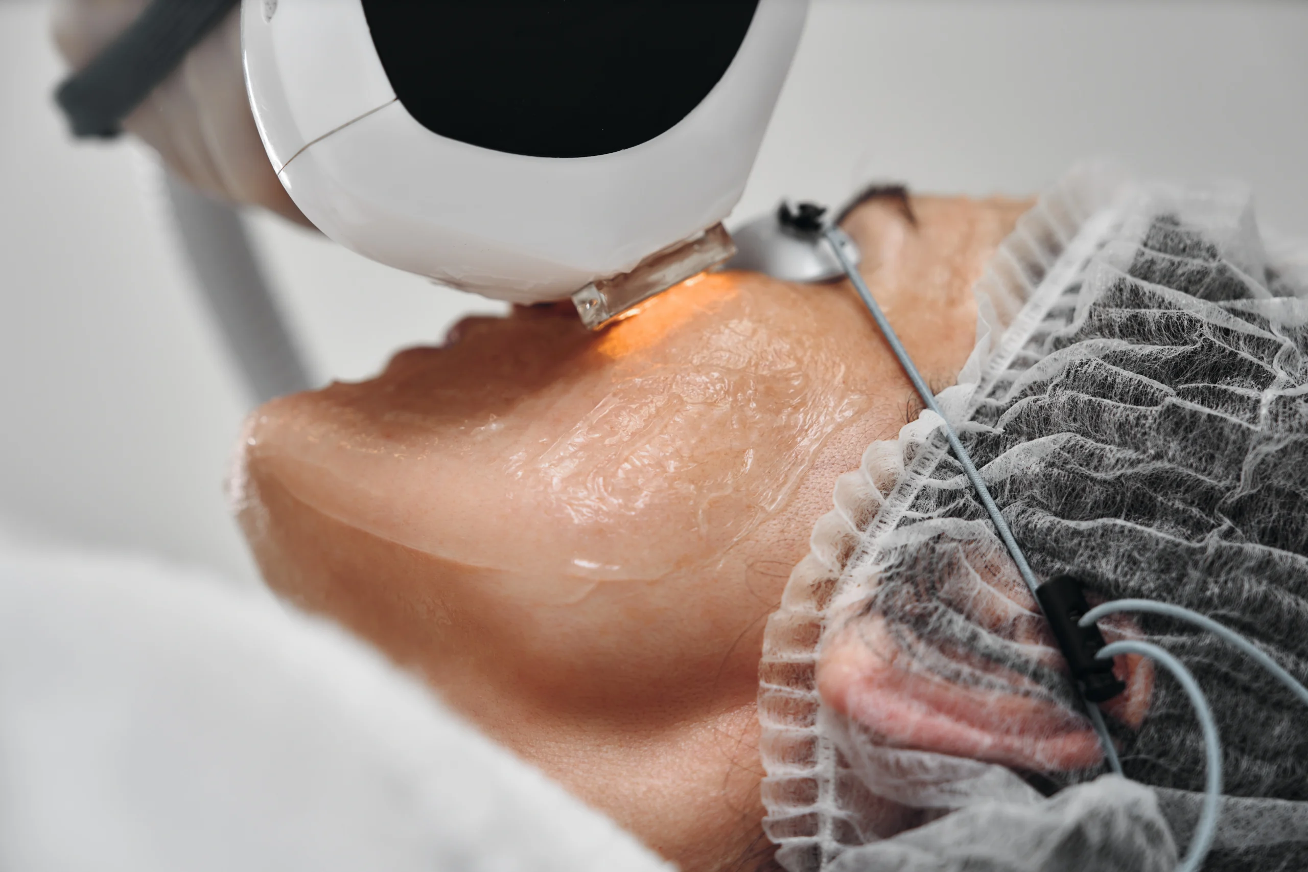 Sciton Laser | Canvas Skin Clinic | Oro Valley, AZ